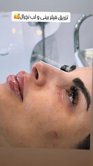 تزریق فیلر بینی و لب نچرال