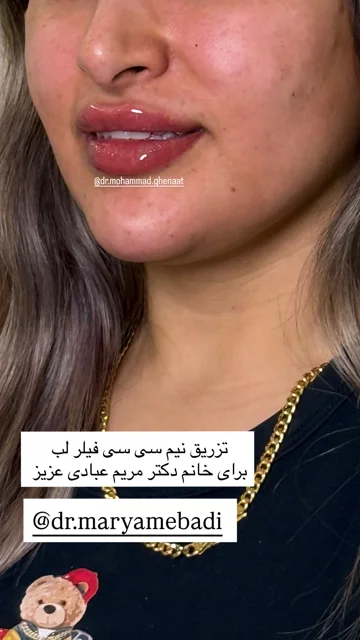 تزریق لب نچرال برای همکار گرامی دکتر مریم عبادی