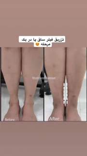 فیلر ساق پا