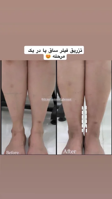 فیلر ساق پا