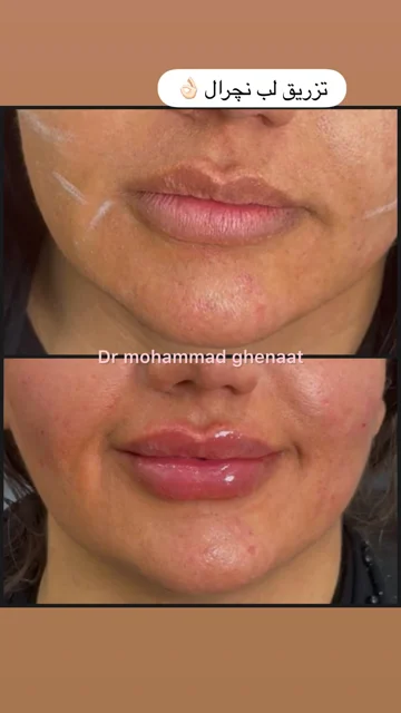 قرینه سازی لب نچرال
