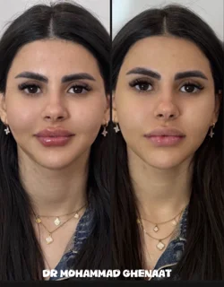 تزریق میدفیس و لب عروسکی