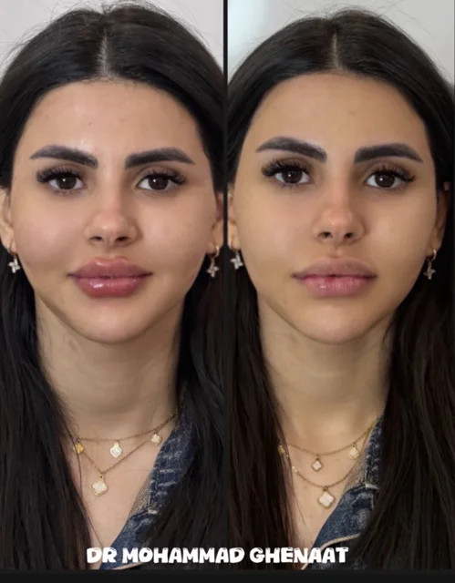 تزریق میدفیس و لب عروسکی